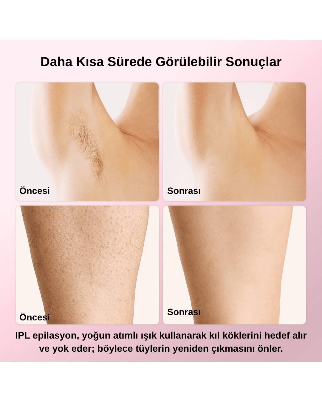 T4 Taşınabilir IPL Lazer Epilasyon Cihazı – Ev Tipi Tüy Giderme Aleti - Görsel 3